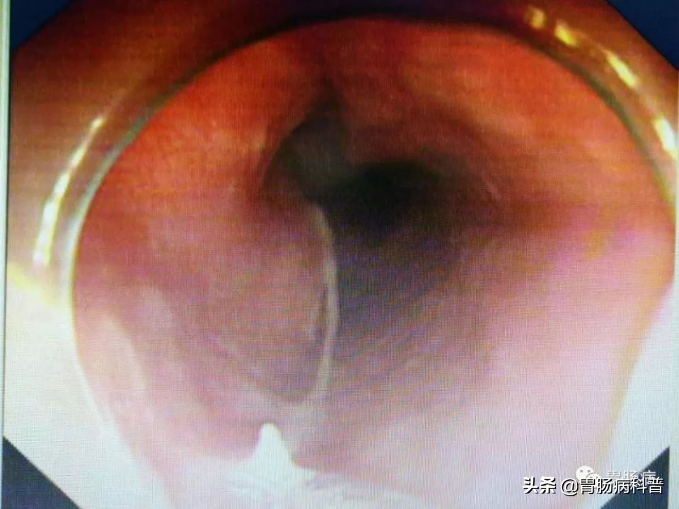 拔鱼刺胃癌早期,取一个鱼刺去了一趟医院