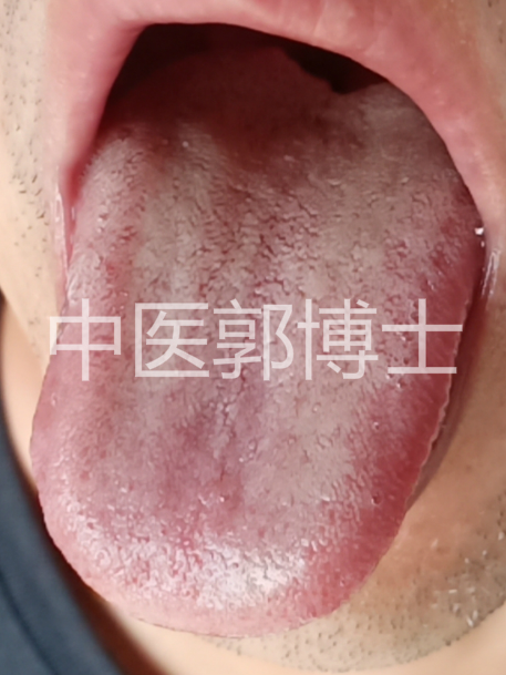 胃脘部嘈杂痞满症状,胃脘痞闷胀满怎么回事