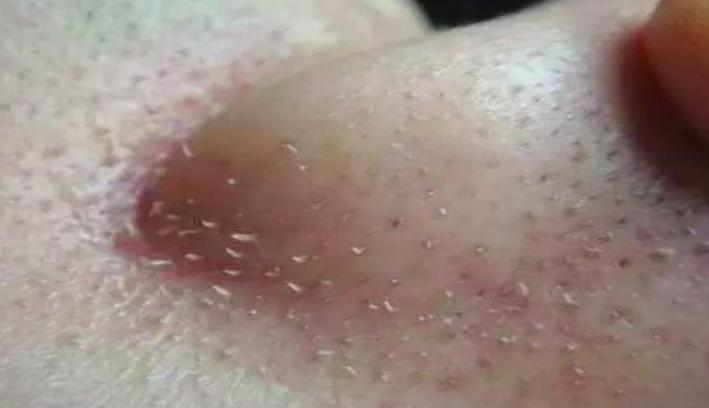 【鼻子最容易挤出这些白色的“条状物”，它到底是什么？】