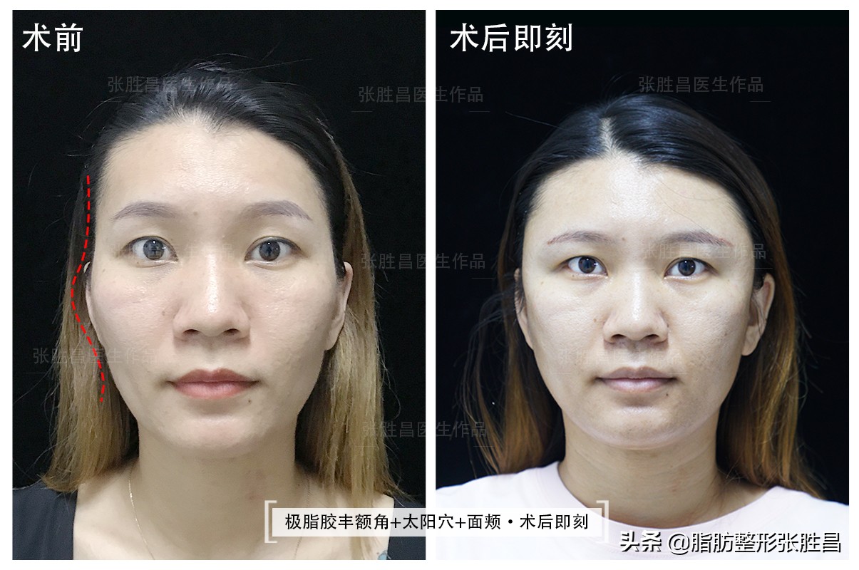 一块骨头把温柔脸变凶脸？她颧骨高如山，不经磨骨之痛却收获了美