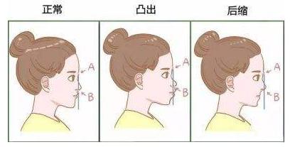 严重的龅牙可以磨掉吗,严重龅牙可以矫正吗