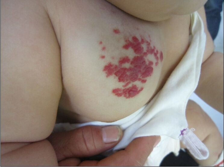 草莓状血管瘤注意事项,草莓状血管瘤婴儿什么时候能自愈