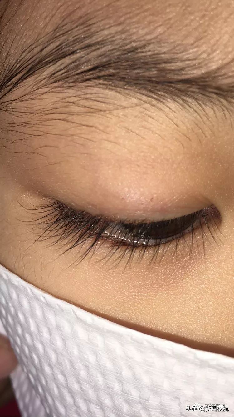 5岁女孩眼睛里取出20多只虱子,还在动!孩子总有这个动作,家长一定要重视