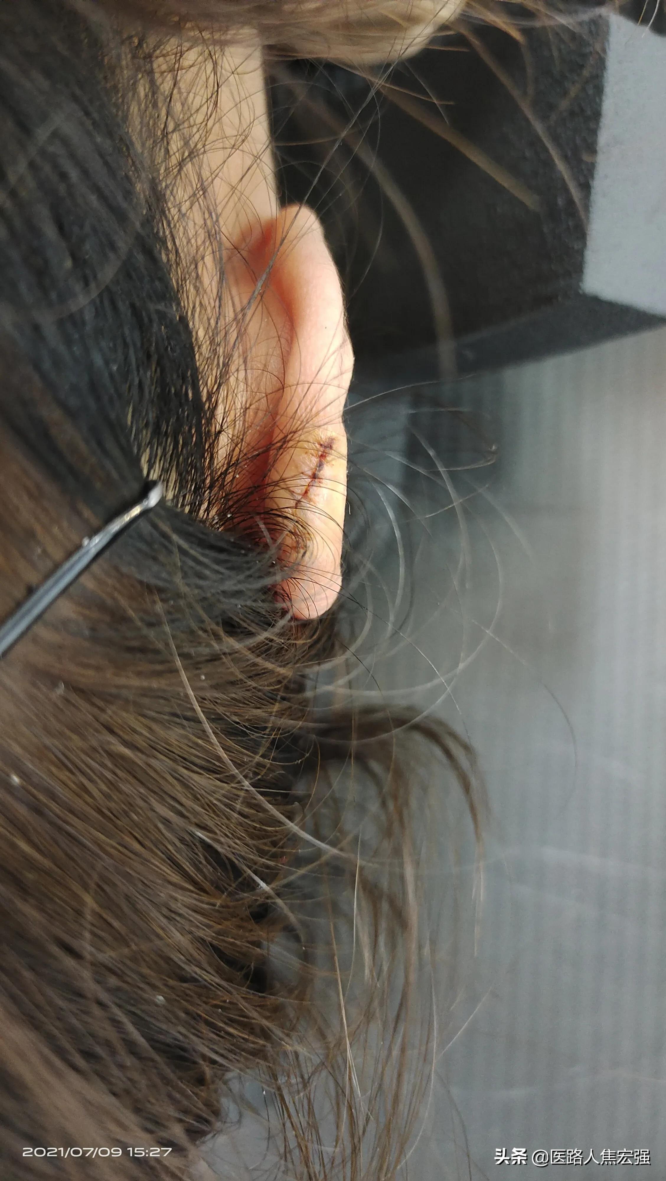 放疗对瘢痕的治疗作用,瘢痕放疗用的是什么射线