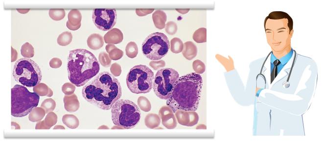 cml是很严重的白血病吗,一附院血液科专家介绍