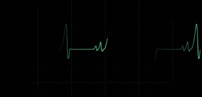 医生！我体检出了窦性心律！先别慌，它不是病！#清风计划#