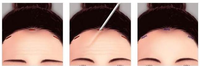 40多岁的人最适合做的除皱项目,目前国内最好的除皱方法是什么