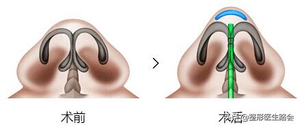 鼻头缩小会留疤么,鼻头缩小会改变高度吗