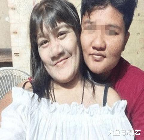 女孩突发怪病脸部疯狂生长,女孩患病满脸毛发