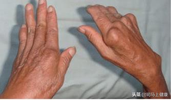 什么是类风湿性关节炎？它有哪些表现？拔罐是怎样治疗的？