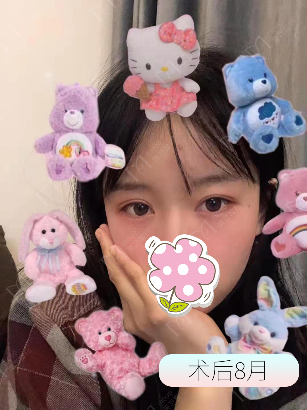 双眼皮失败了怎么修复好,双眼皮修复失败怎么解决