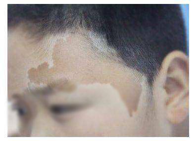 胎记真实身份,胎记是怎么形成的原因