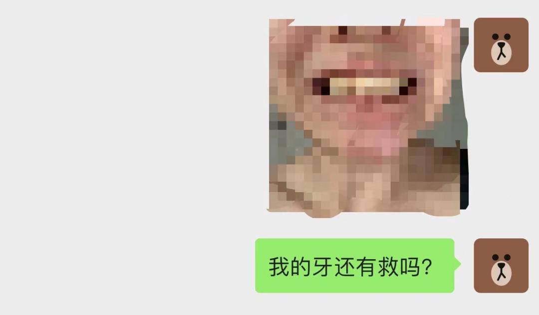 9块9隐形牙套,在家自制透明牙套