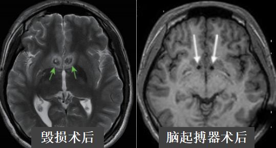 脑起搏器dbs是什么意思,dbs脑起搏器哪里做最好