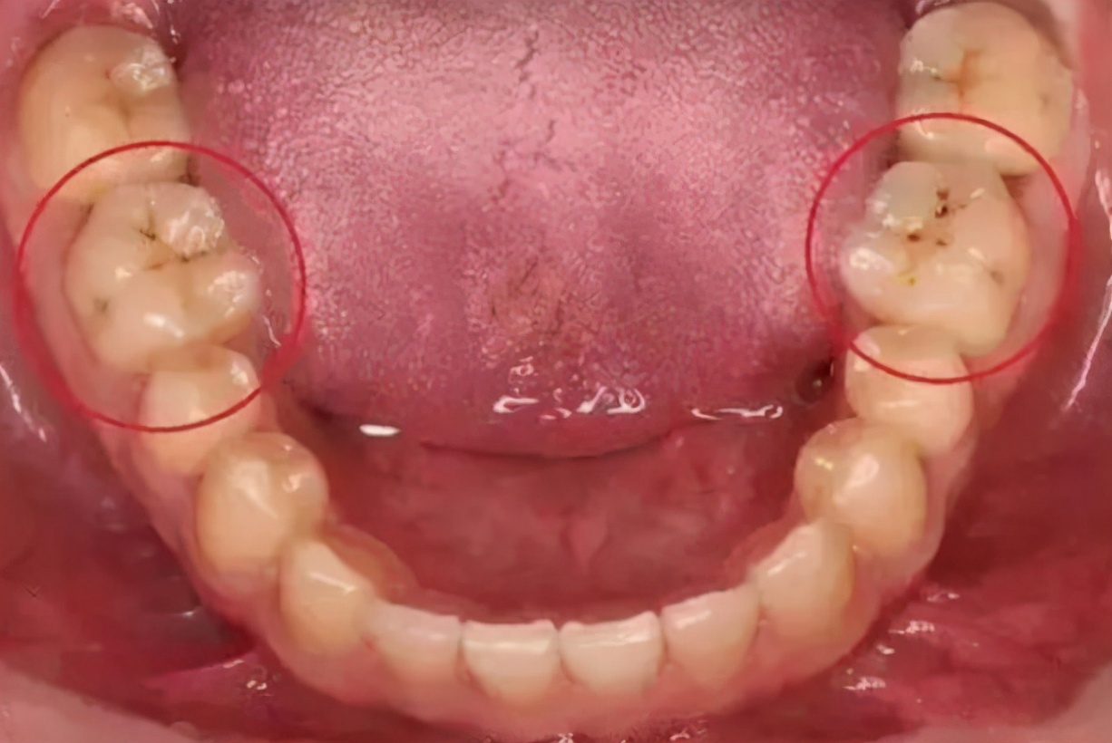 牙齿有小黑点医生不处理直接补上,牙齿上有黑点不补牙怎么样解决