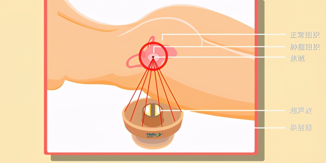 子宫肌瘤微创手术海扶刀,子宫肌瘤海扶刀适合做的人群
