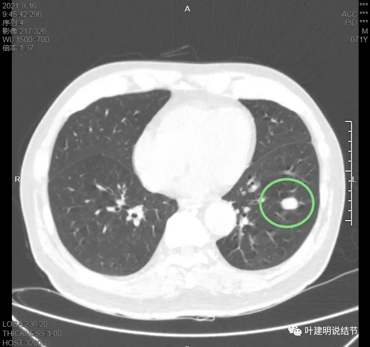 肺上有实性结节6mmx5mm是什么原因,肺上有1.7x1.8的实性结节该怎么办