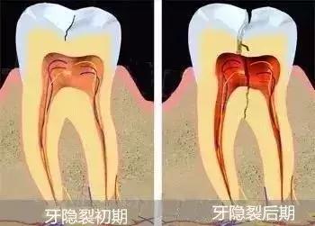牙齿咬到硬物裂了一小块,牙齿咬到沙子疼痛的原因