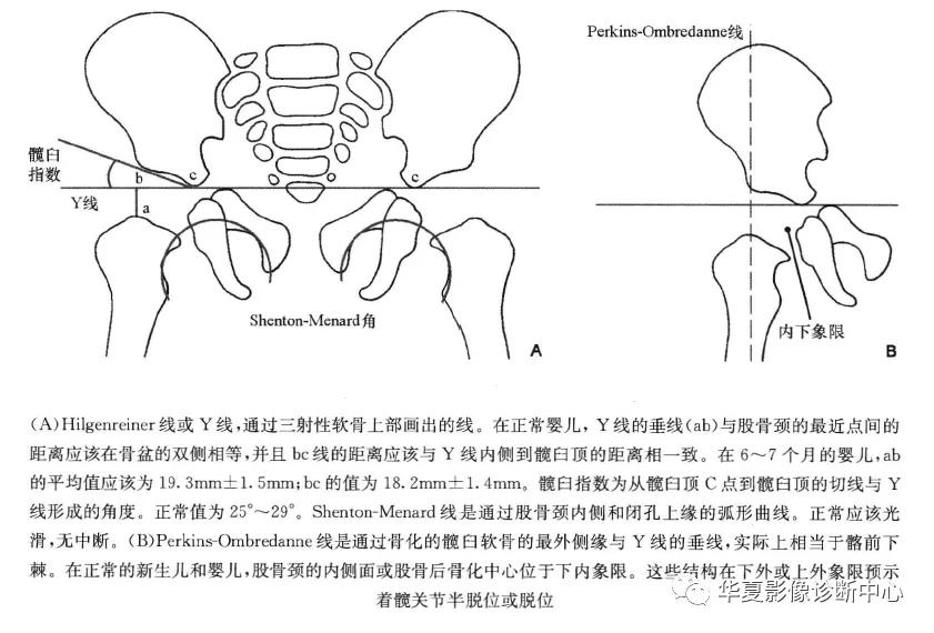 儿科先天性髋关节脱位的分型为,先天性髋关节脱位分级