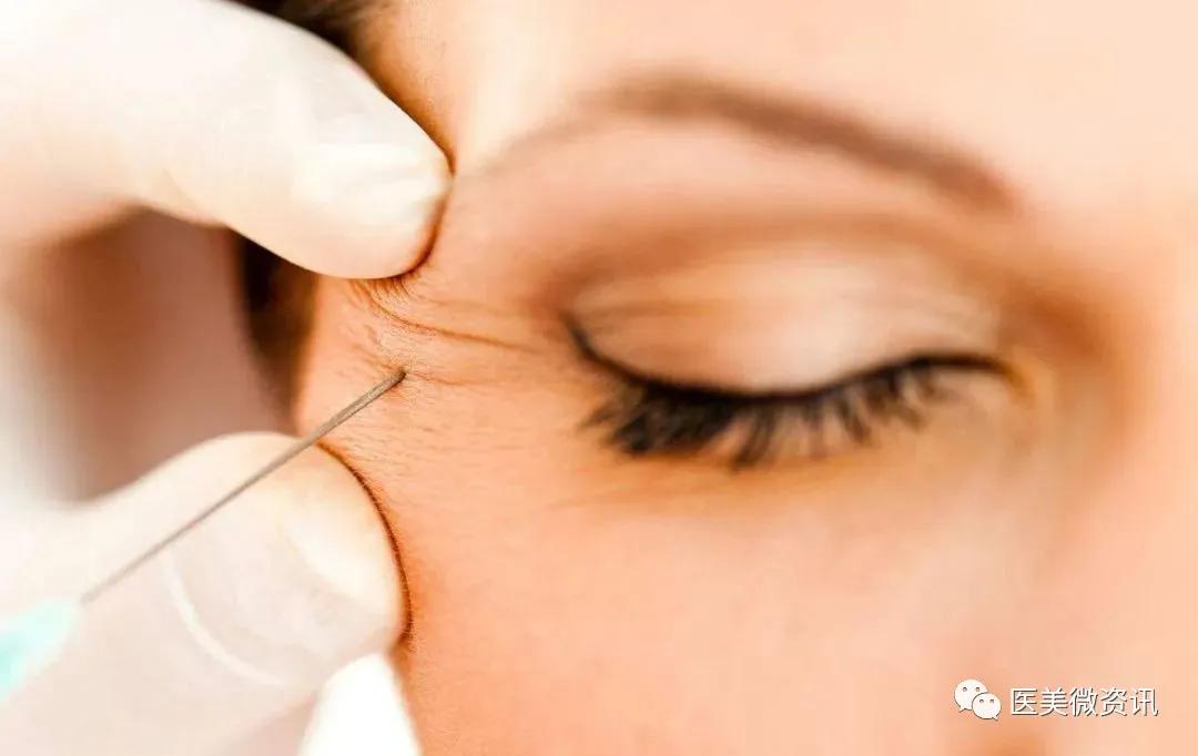 眼周祛皱,眼周祛皱什么项目好