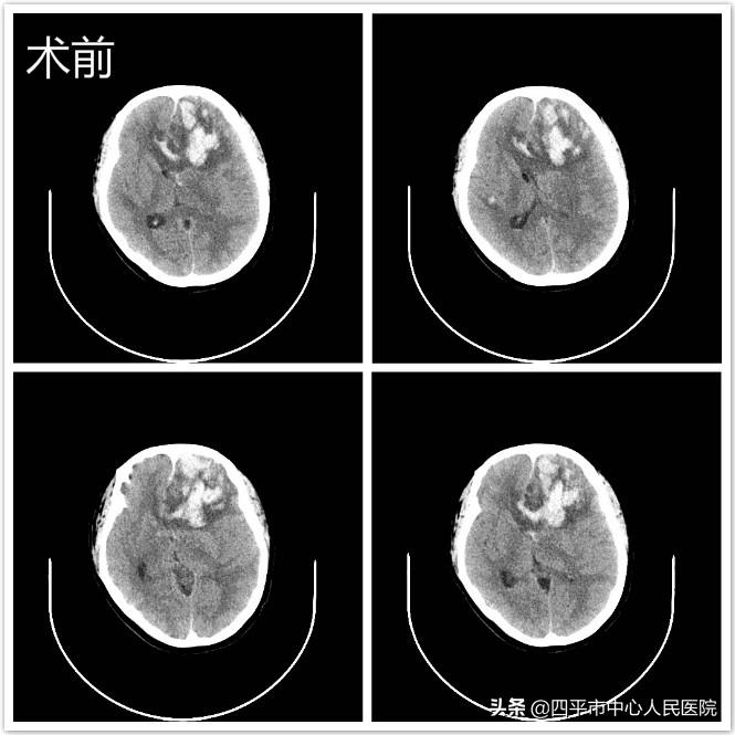 再创生命奇迹——神经外科成功救治白血病继发脑出血病危患者