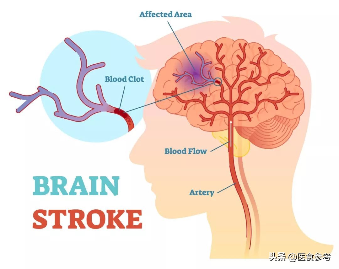 中国人为什么脑卒中多,扼杀人类健康第一元凶脑卒中