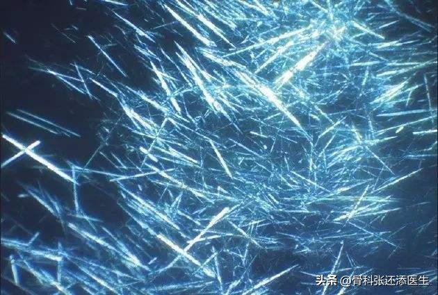 痛风能治愈?尿酸监测,药品选择,除了戒口,我们聊点深入的科普