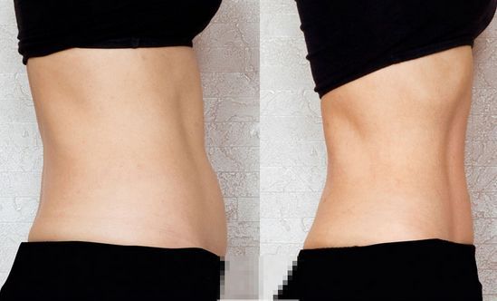 吸脂为什么没多大变化,吸脂真的会有很大的改变吗