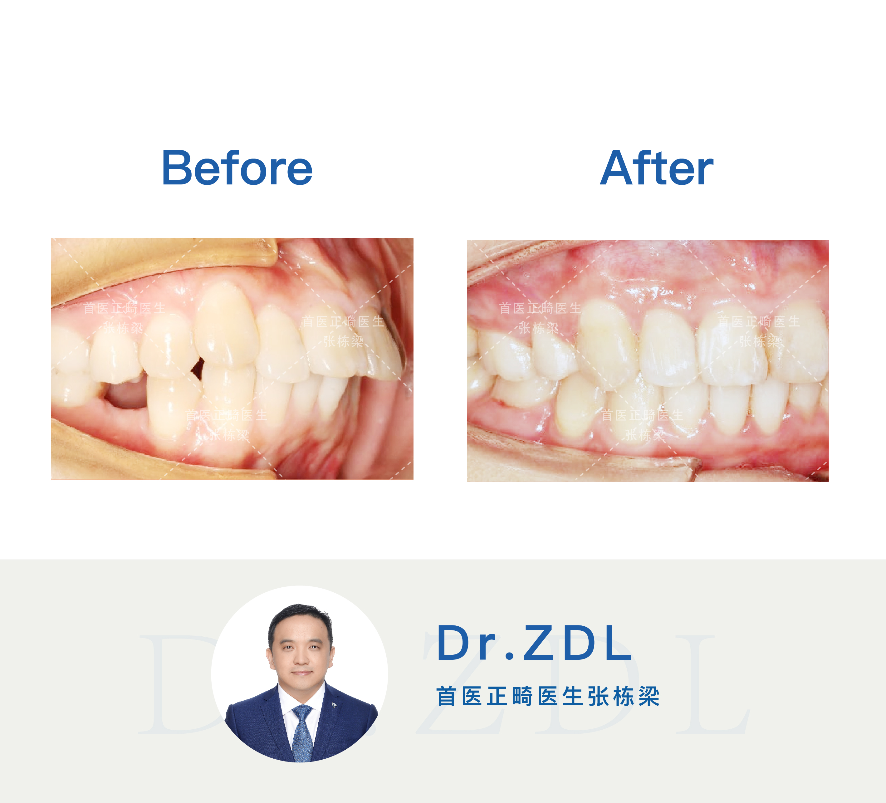 24岁戴牙套矫正效果能有效吗,40岁戴隐形牙套矫正牙齿经历