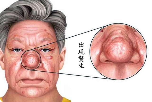 疮疤性痤疮,玫瑰痤疮早期怎么治