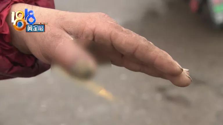 伤口拆线后多久没包纱布了,拆线后发现伤口有小白点