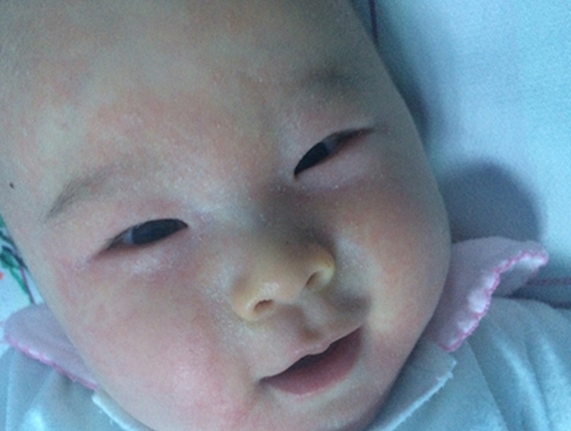 月嫂怎样解决宝宝湿疹问题,宝宝湿疹有妙招月嫂分享