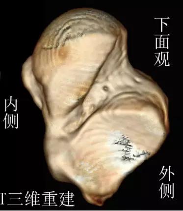 踝关节撞击症问诊,踝关节撞击综合征的x线表现