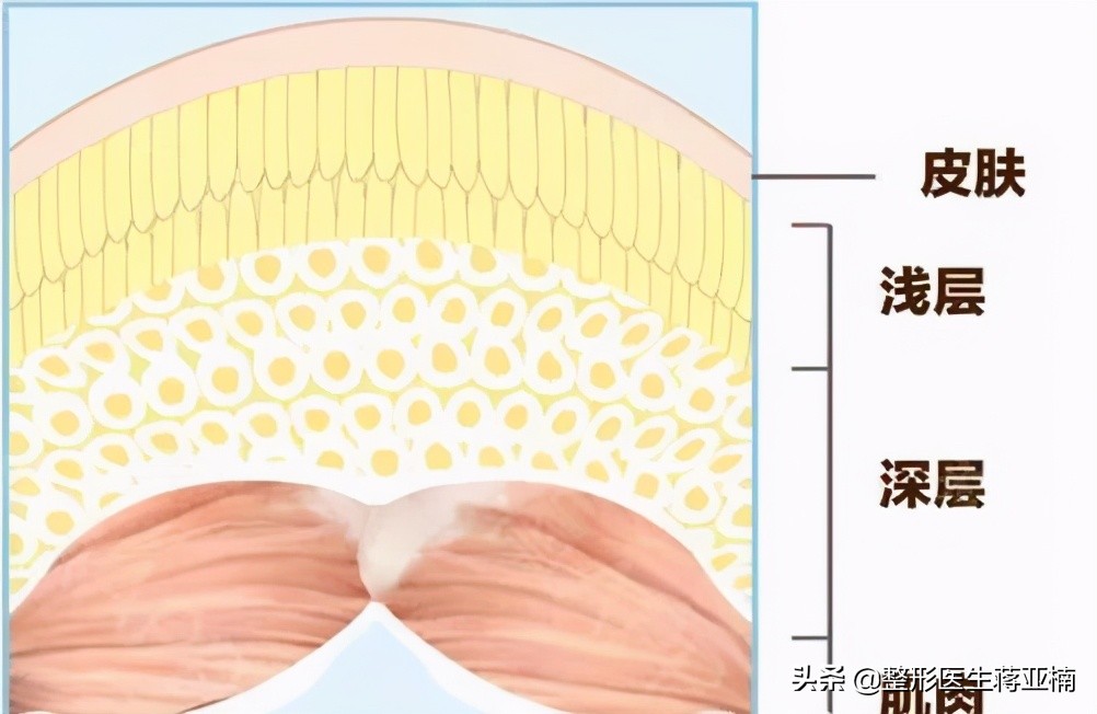 苹果肌吸脂抽出来的是血水,下额吸脂吸出来的都是血水
