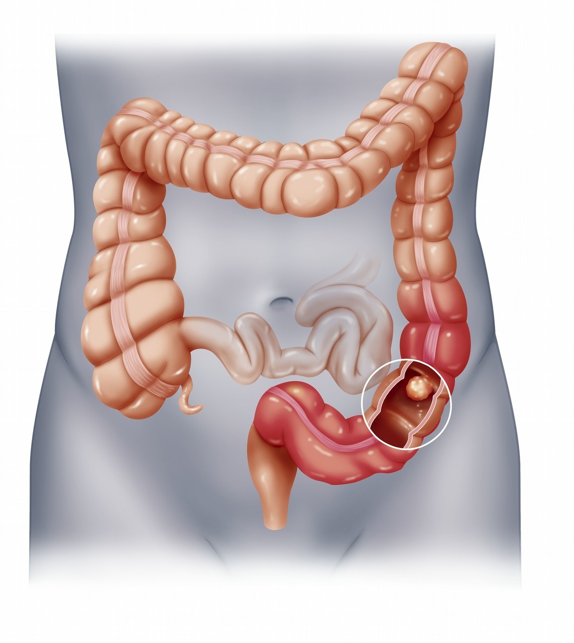 肠癌肠造口科普知识讲解,结肠癌造口小肠还是大肠