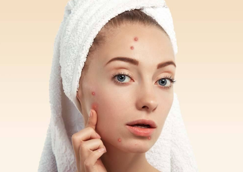 如何快速祛痘:痘痘分四个等级,你属于哪一级?