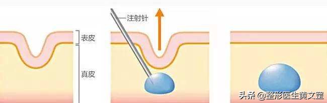 有了泪沟显老怎么办,有没有办法解决后天泪沟