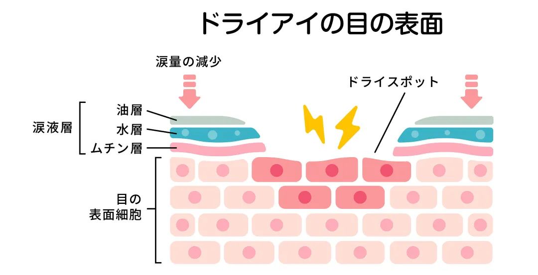 有效去除眼纹眼霜,眼纹可以通过医美什么方式治疗