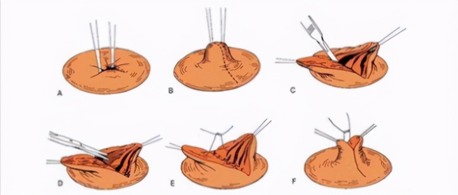 捂脸！乳头像火山口般凹陷，会影响哺乳功能吗
