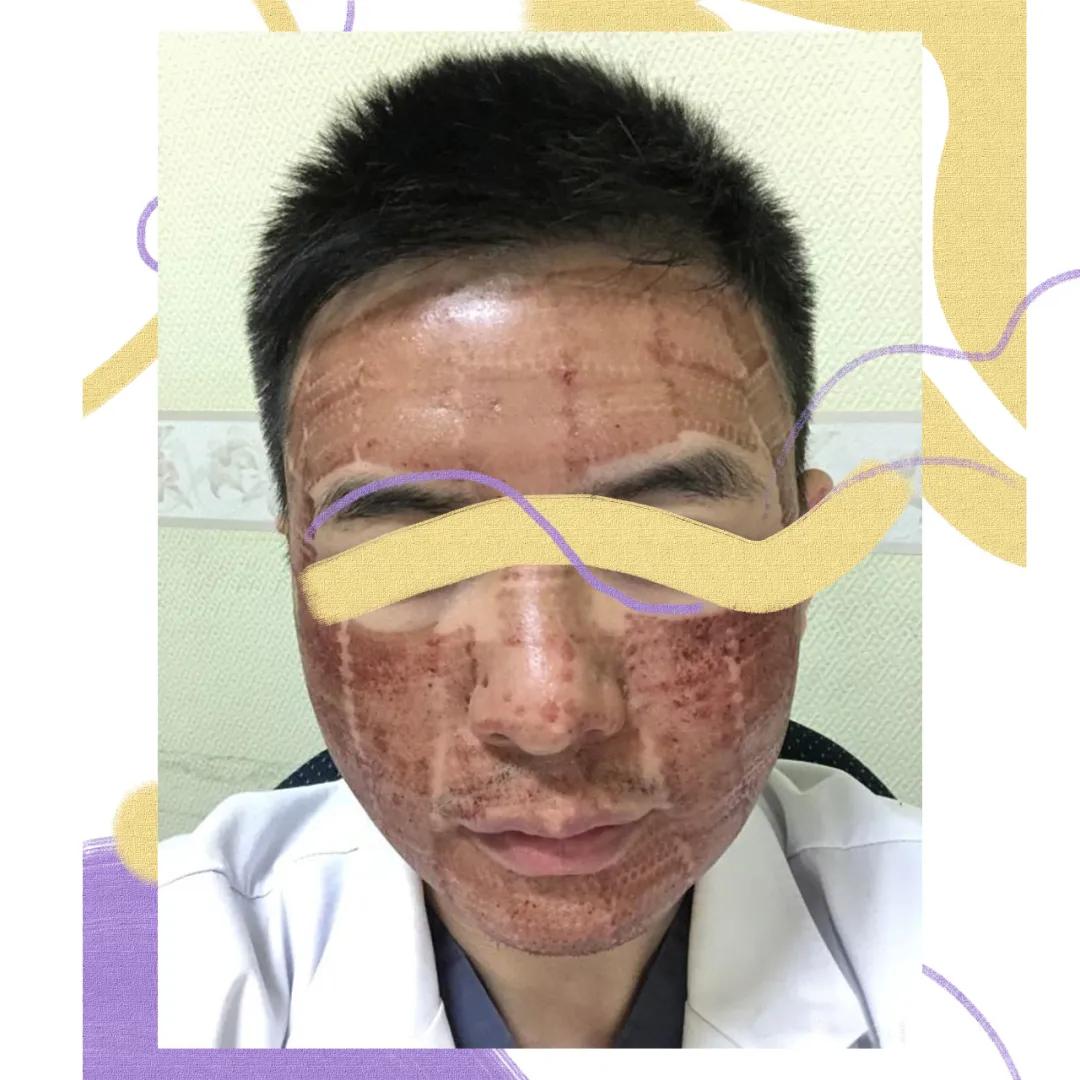 医美做什么能永远不长痘,脸很多痘坑做什么医美