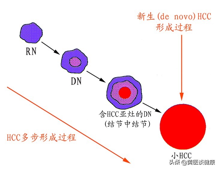 治疗乙肝7年，肝功能一直正常，但出现肝硬化结节，怎么办？