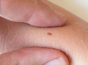 皮肤上长了一个痣怎么办,皮肤上长痣是什么癌