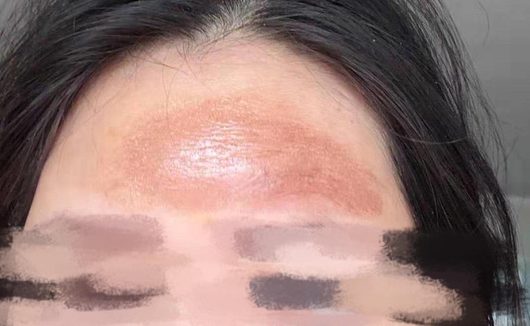 脂肪填充深圳哪家医院做得好,脂肪填充后悔案例