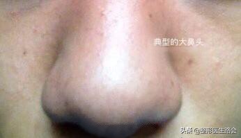 鼻头缩小后鼻孔里增生了,鼻头鼻翼缩小疤痕增生怎么办