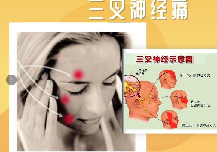 如何缓解三叉神经痛,面部三叉神经痛治疗方法