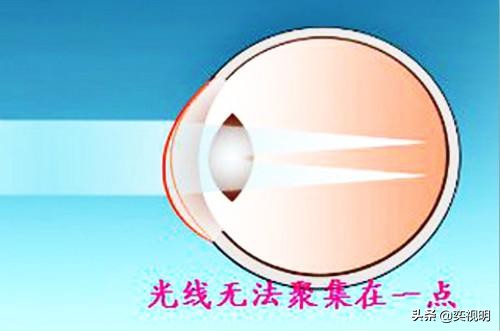 有散光超长佩戴如何选择隐形眼镜,眼睛散光不戴眼镜有哪些害处