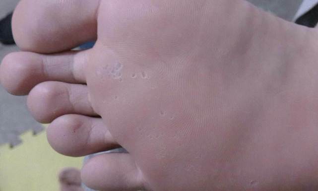 麻疹是什么病机,麻疹与荨麻疹的区别有哪些