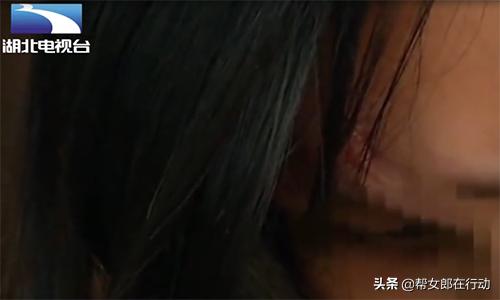 整容失败眼睛失明的案例,玻尿酸隆鼻手术失明