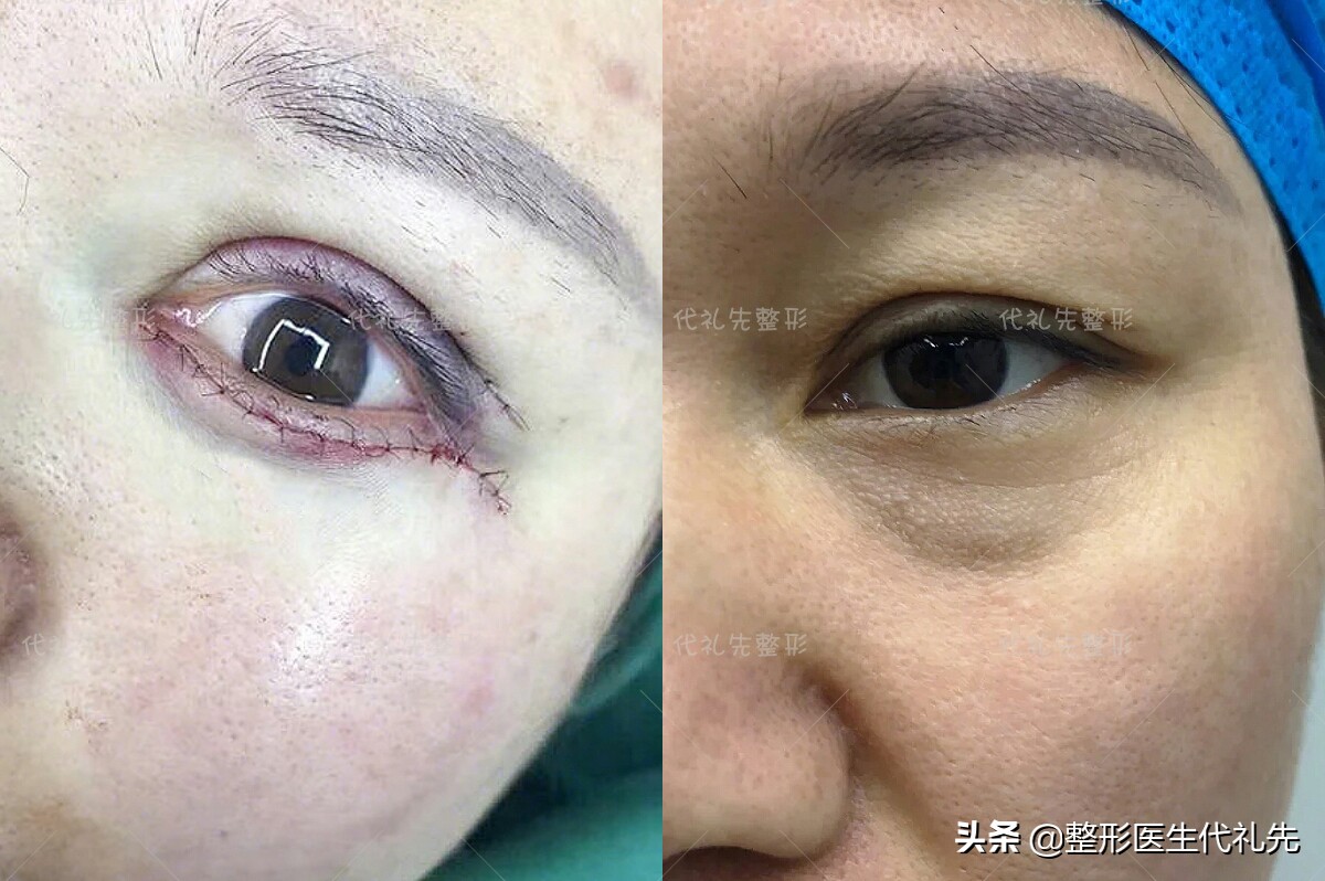 微创祛眼袋和手术开刀哪种效果好,祛眼袋手术术后眼睛青紫怎么办