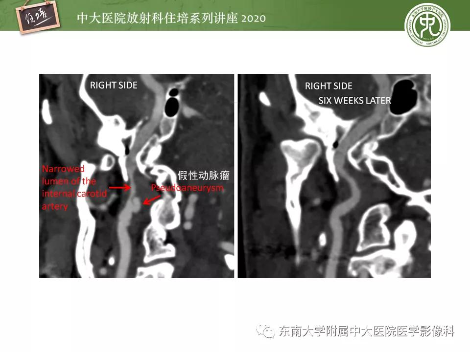 颈动脉夹层的超声表现及漏诊分析,动脉夹层与夹层动脉瘤是一样的吗